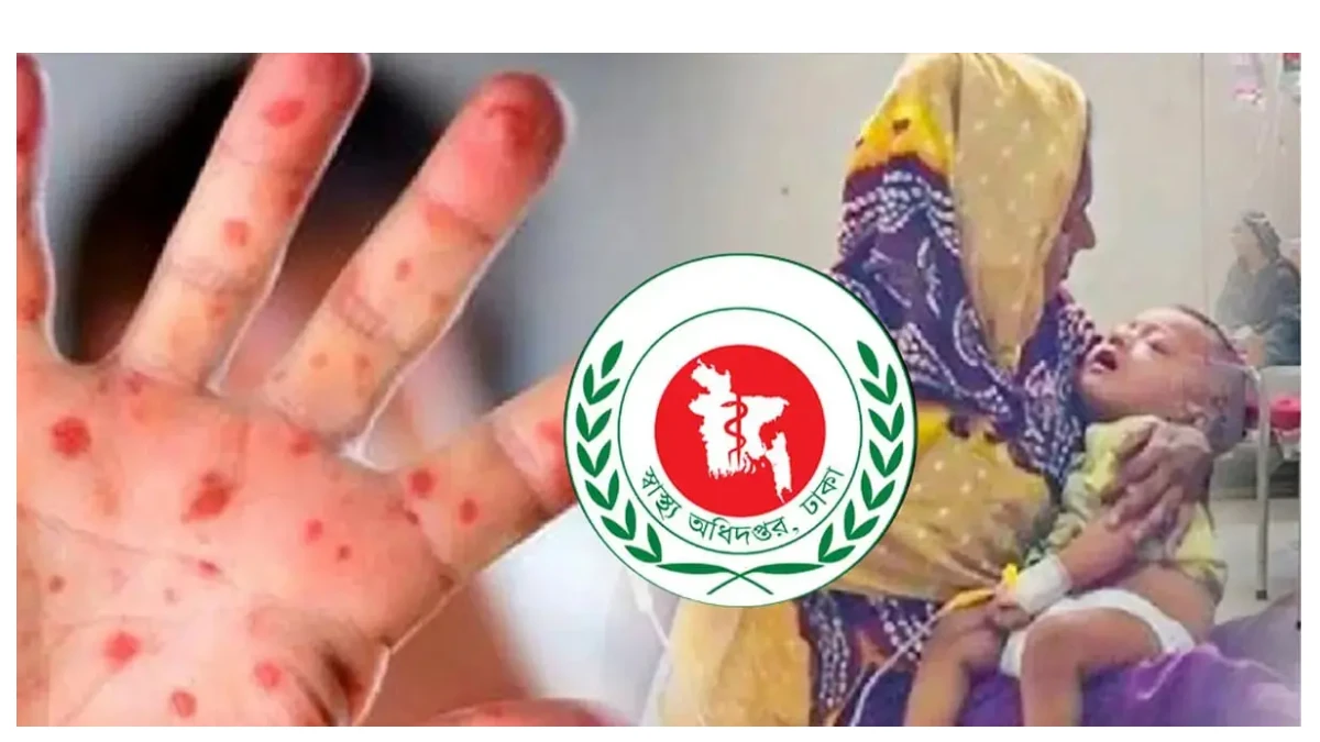 ২৪ ঘণ্টায় হামের উপসর্গে আরও ১০ শিশুর মৃত্যু, মোট প্রাণহানি ৫৭৫